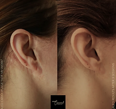 Before and After Camouflage Tattoo Woman's facelift scar behind ears