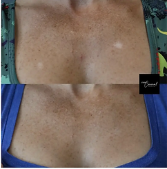 Before and After Woman's chest hypopigmentation
