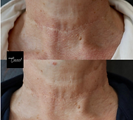 Before and After Camouflage Tattoo Woman's Neck Scar