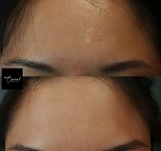 Before and After Camouflage Tattoo on forehead