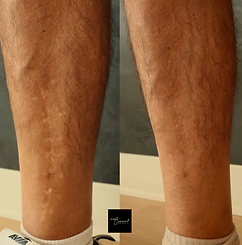 Before and After Scar Camouflage on man's leg post surgery