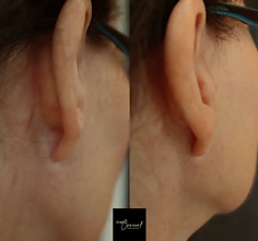 Before and After Woman's facelift scar behind ears