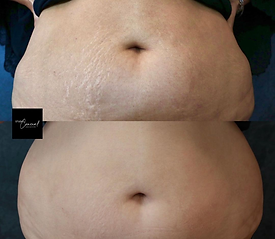 Before and After stretch mark rejuvenation on woman's belly