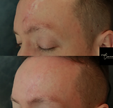 Before and After Color Matched Tattoo Scar on Woman's forehead