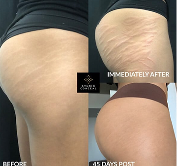Before, during and After photo of stretch marks healing