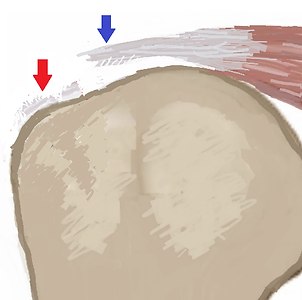 Vollständiger Abriss der Spuraspinatussehne