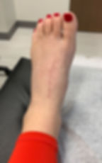 After Blading Treatment