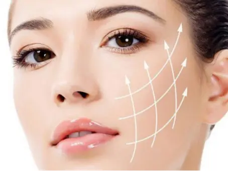 Căng Chỉ collagen vùng mắt và những điều cần biết