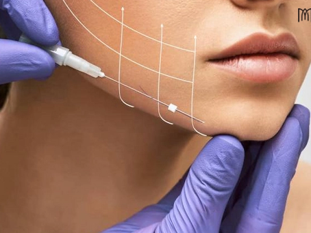 Cấy Chỉ Nâng Cơ Mặt Là Gì? Lợi Ích Và Quy Trình Thực Hiện