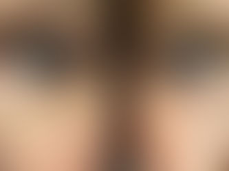 Căng chỉ collagen vùng mắt như thế nào, có an toàn không?