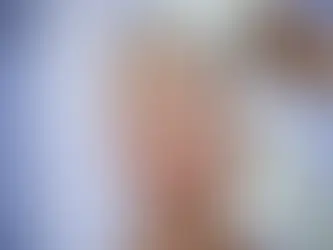 Hé lộ mức giá làm đầy thái dương lõm không cần phẫu thuật