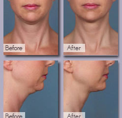 DITCH THAT DOUBLE CHIN!