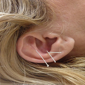 5 auriculoterapia 2.jpg