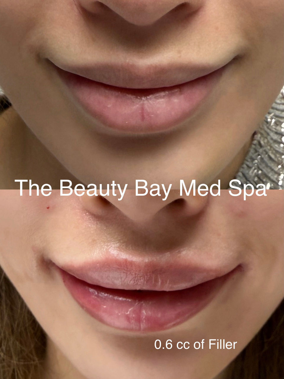 filler before and after