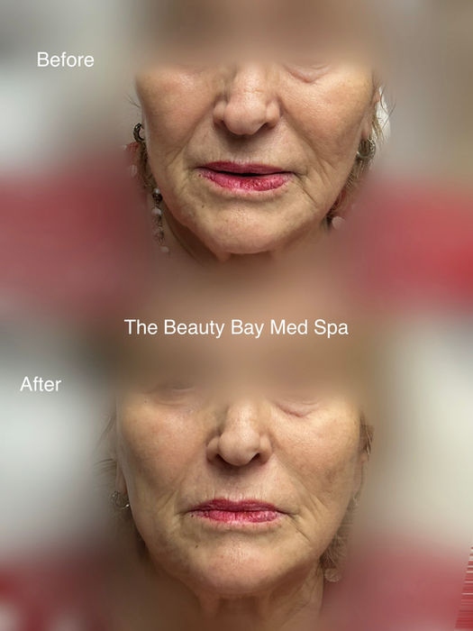 radiesse before n after
