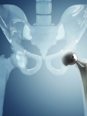 Precautions After a Joint Replacement Surgery