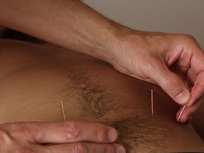 Acupuncture.JPG