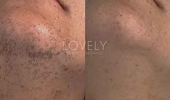 Mento tre sedute laser diodo Collegno Centro estetico Lovely BT Torino