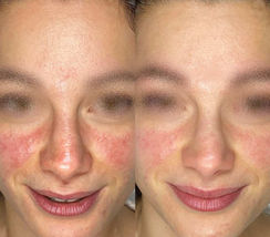 couperose Collegno trattamenti viso