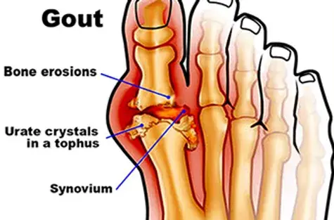 Gout