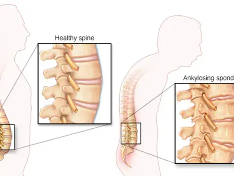 Ankylosing Spondylitis