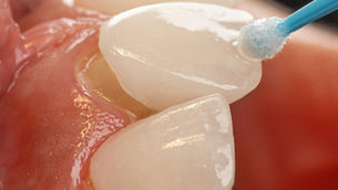 Close-up of white teeth being cleaned with a blue swab, with pink gums in warm light.