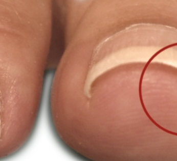 Ingrown-toenail-Pic-1-768x369_edited_edited_edited_edited.png