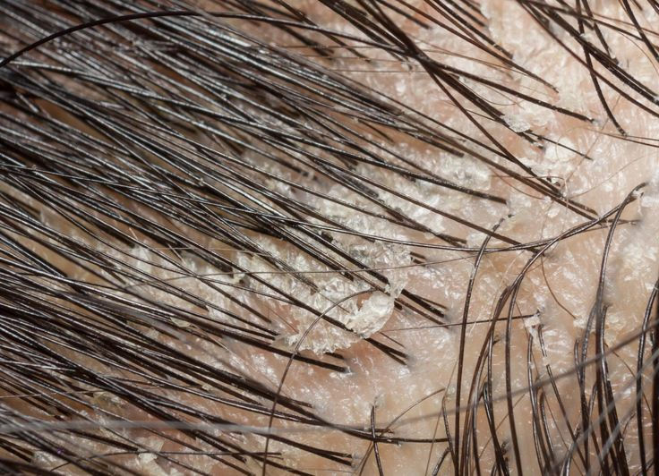 Why Scalp Health Is the Secret to Beautiful Hair