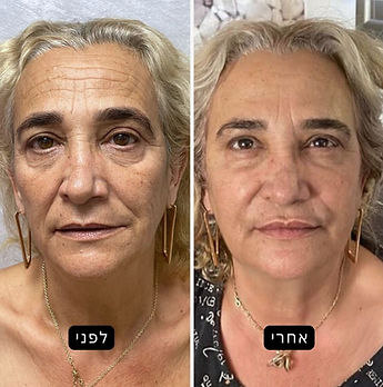 לפני אחרי טיפול חומצה פולילקטית אסטפיל בנתניה ליאור אבשלום