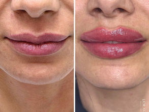 שפתיים מושלמות, חיוך בוהק: כל מה שאת צריכה לדעת על שיטת הפפיון