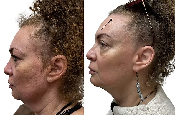 טיפול בקמטי הבעה בוטוקס באוסטראה אסתטיקה בנתניה