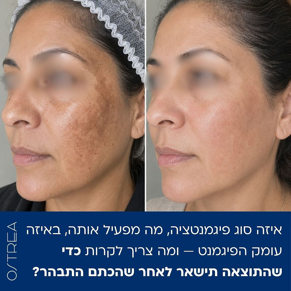 לפני ואחרי טיפול פיגמנטציה מזלמה הורמונלית במרכז אסתטיקה אוסטראה בנתניה 