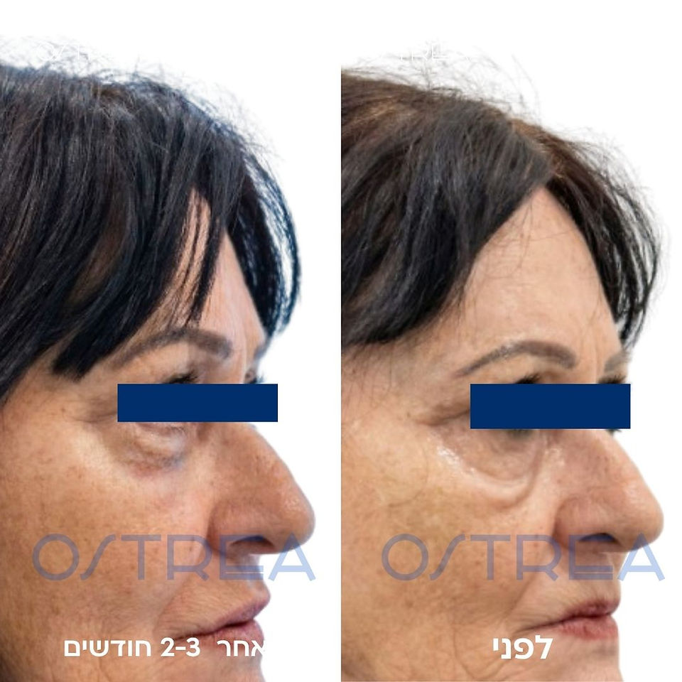 תמונה המציגה לפני ואחרי טיפול שקיות וקמטים מתחת לעיניים לאחר הליך טיפול אסתטי אנדוליפט לייזר במרכז אסתטיקה אוסטראה בנתניה המטפל גם בשקיות שומן ואזור עיניים
