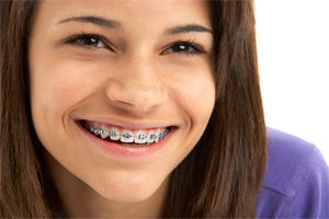 teenage girl with braces