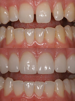 veneers, teeth alignment, seven hills smile excellence dentistry