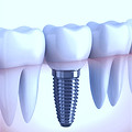 implante-dentario_edited_edited_edited.jpg