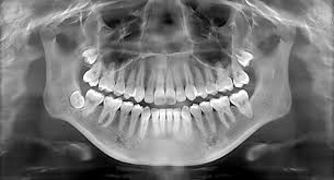 What To Know About Dental X-Rays