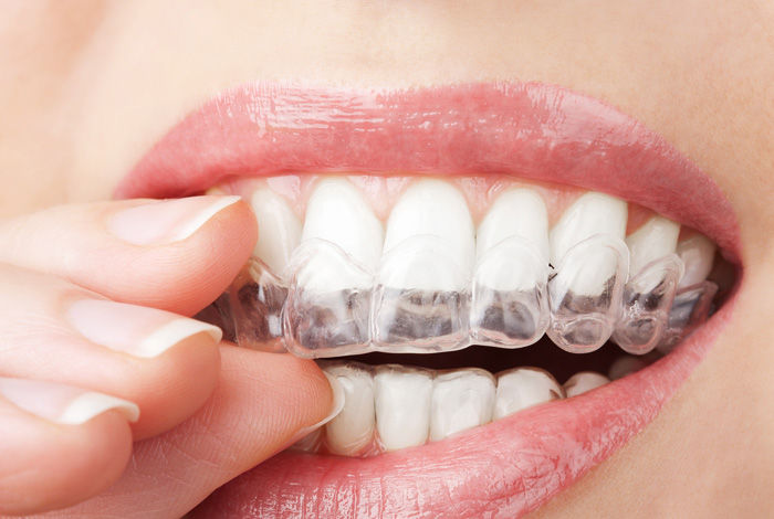 Do you grind or clench your teeth when you�re sleeping or