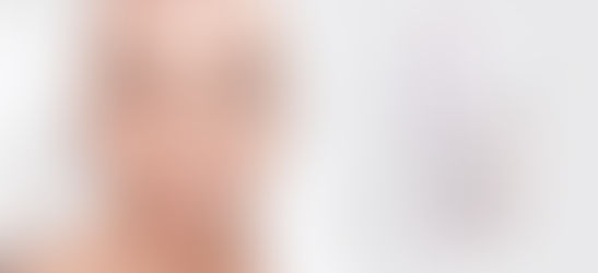 Hyalurolift How Skin Types Can Affect Your Choice of Anti Aging Skin Cream