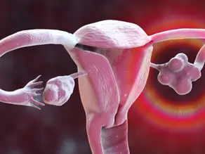 PCOS Has Been Renamed And I've Been Waiting for This Moment