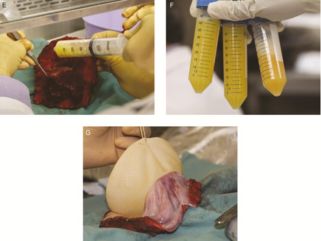 How do you treat BIA-ALCL?