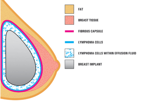 BIA-ALCL (Breast Implant Associated Anaplastic Large Cell Lymphoma)