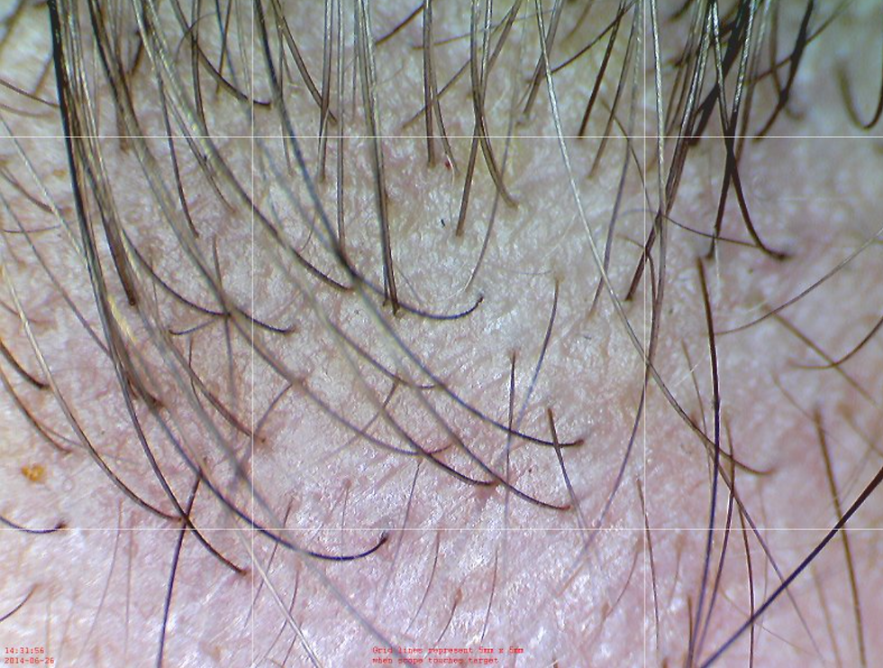 Thumbnail: DE300 Polarizing Dermatoscope / Dermascope