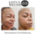 Skin Laxity Treatment