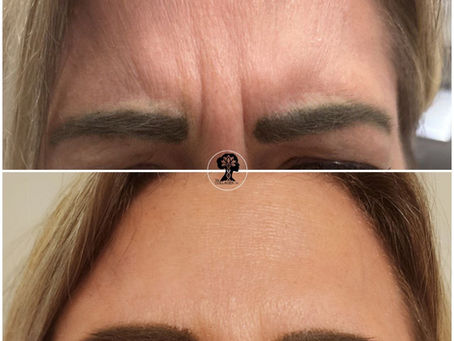 Your Ultimate Skin-Tightening Starter Pack