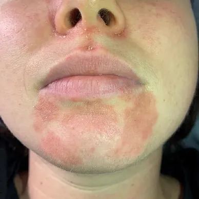 Celluma-Pro-Before-After-10.webp