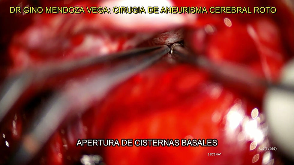 CX ANEURISMA CON AUDIO.mp4