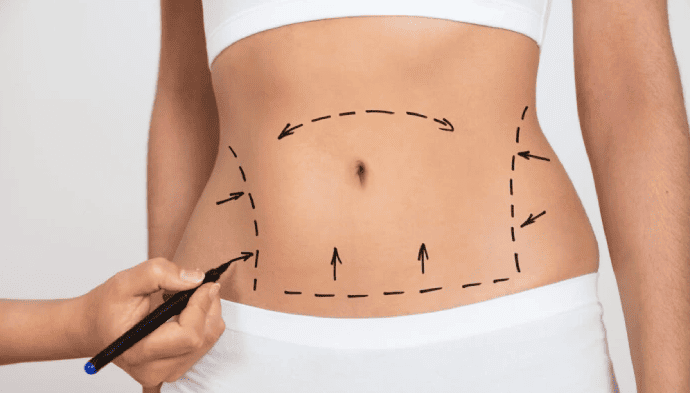 Tummy Tuck
