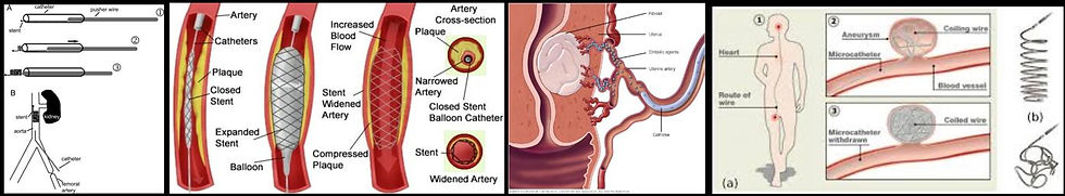 usage of X-Ray Interventional Technology to perform minimally invasive procedure