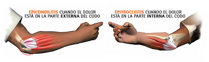epicondilitis5.jpg
